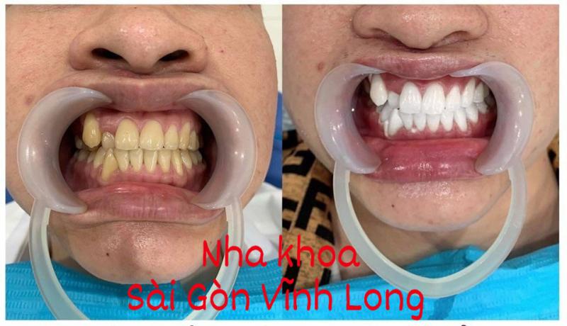 Nha Khoa Sài Gòn Vĩnh Long