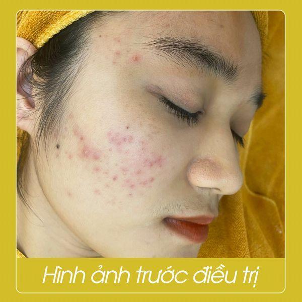 La Beauty – Spa Trị Mụn Tại Đà Nẵng