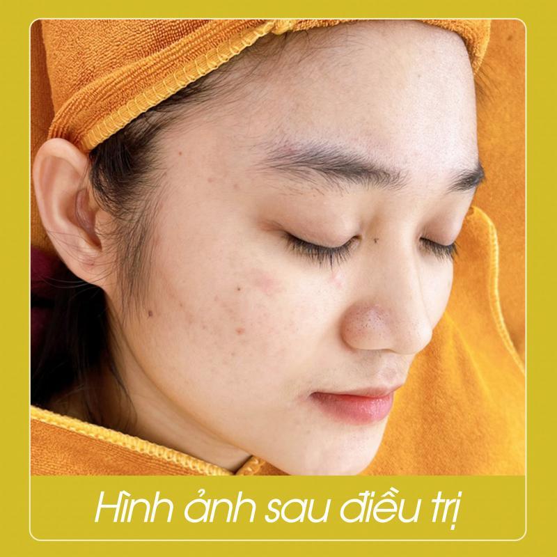 La Beauty – Spa Trị Mụn Tại Đà Nẵng